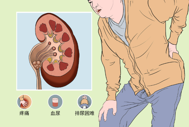 比较实用的预防泌尿结石方法
